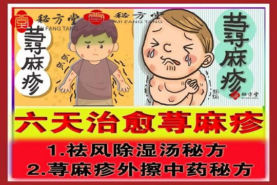 秘方堂提供荨麻疹三方,六天治愈荨麻疹外擦方,内服方,家传方6.8元第1张-秘方堂